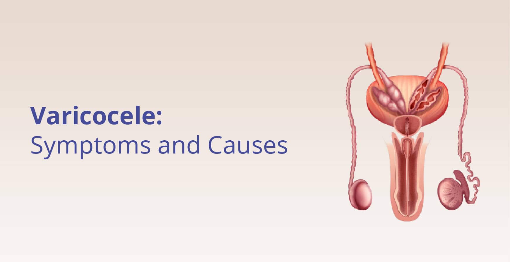 Varicocele – Causes, Symptoms, Diagnosis, & Treatment