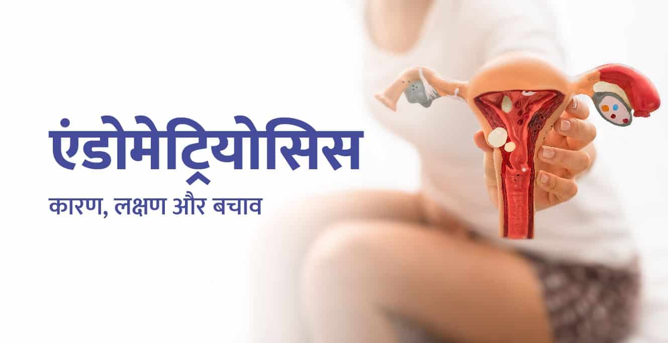 एंडोमेट्रियोसिस क्या है – कारण, लक्षण और बचाव (Endometriosis in Hindi)