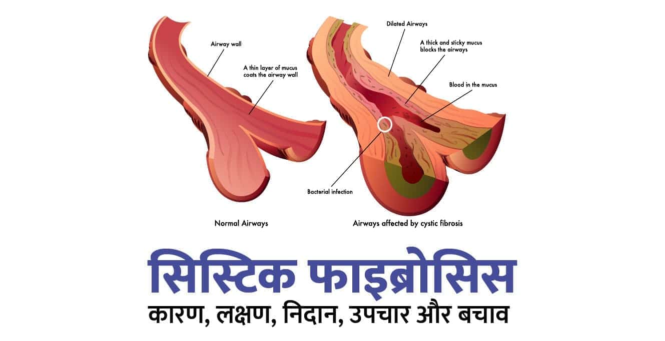 सिस्टिक फाइब्रोसिस के कारण, लक्षण, उपचार और बचाव (Cystic Fibrosis in Hindi)