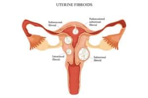 Types of Uterine Fibroids