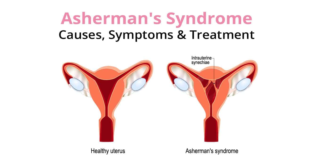 ஆஷெர்மன்ஸ் சிண்ட்ரோம்: காரணங்கள், அறிகுறிகள் மற்றும் சிகிச்சை