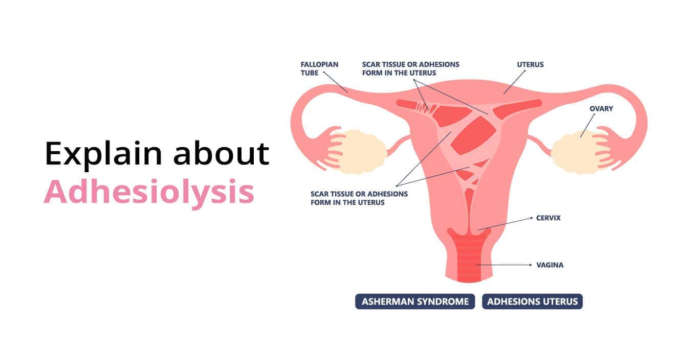 Complete guide to Adhesiolysis: Causes, Diagnosis, and Risks Involved