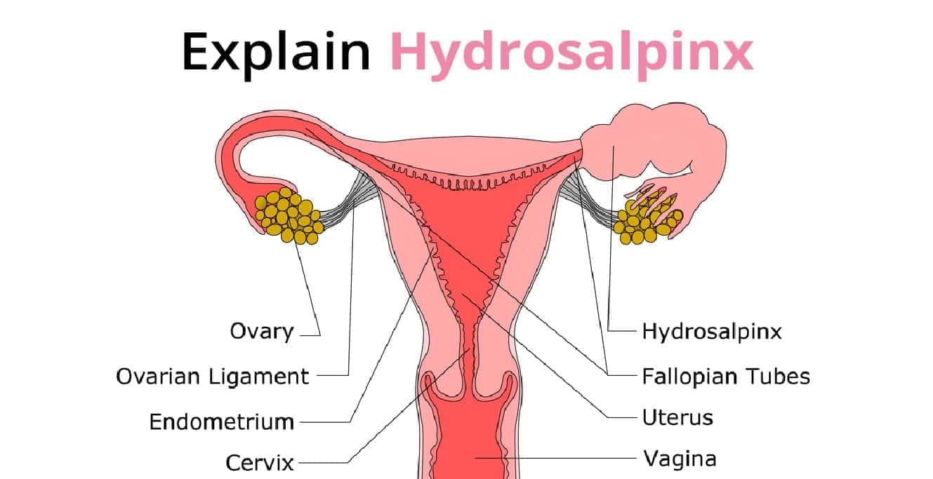 What is Hydrosalpinx Causes, Symptoms and Treatment