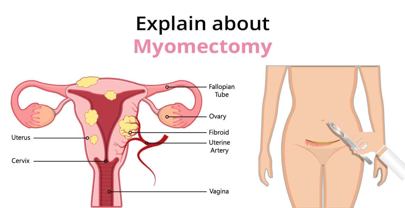 What is Myomectomy? – Kinds, Risks & Complications