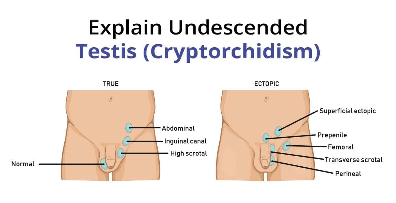 Undescended testis (cryptorchidism)