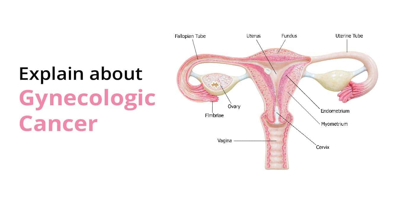 What is Gynecologic Cancer & Its Types