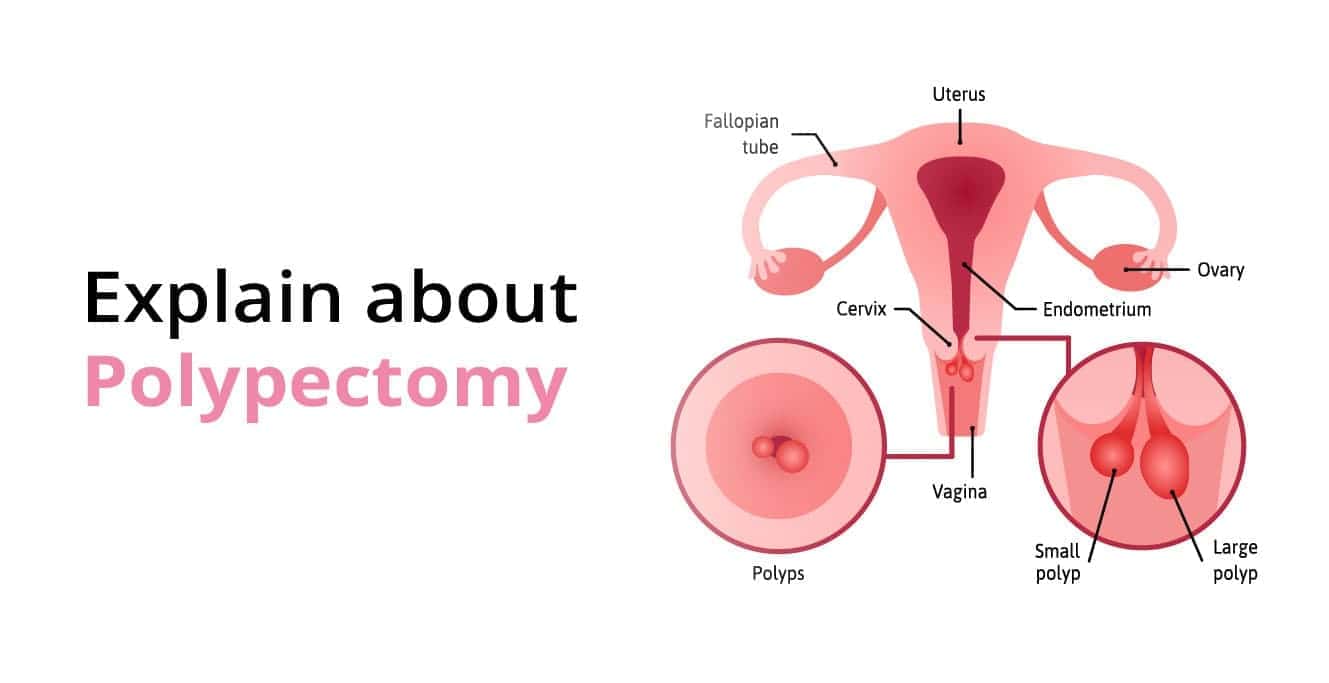 பாலிபெக்டோமி: பாலிப் அறிகுறிகள், நோய் கண்டறிதல் மற்றும் சிகிச்சைகள்