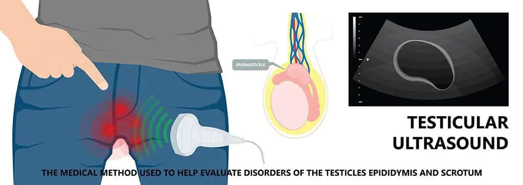 Spermatocele Causes