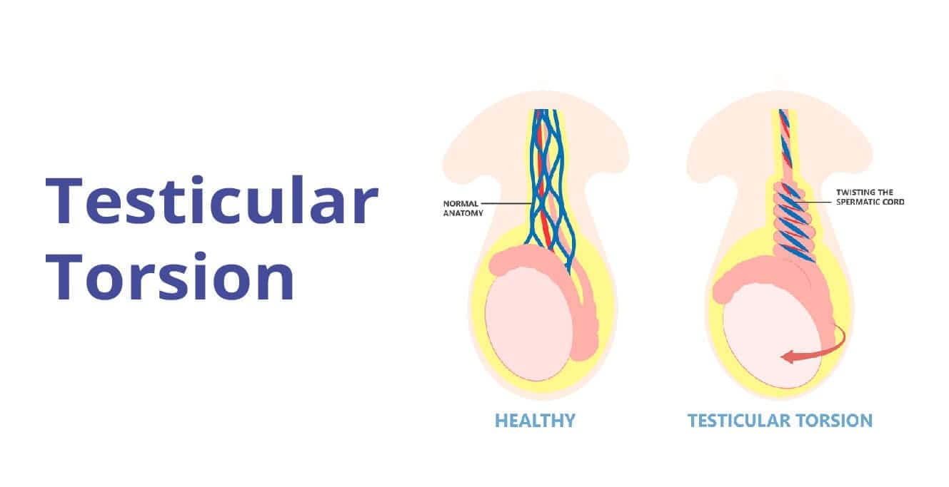 What is Testicular Torsion