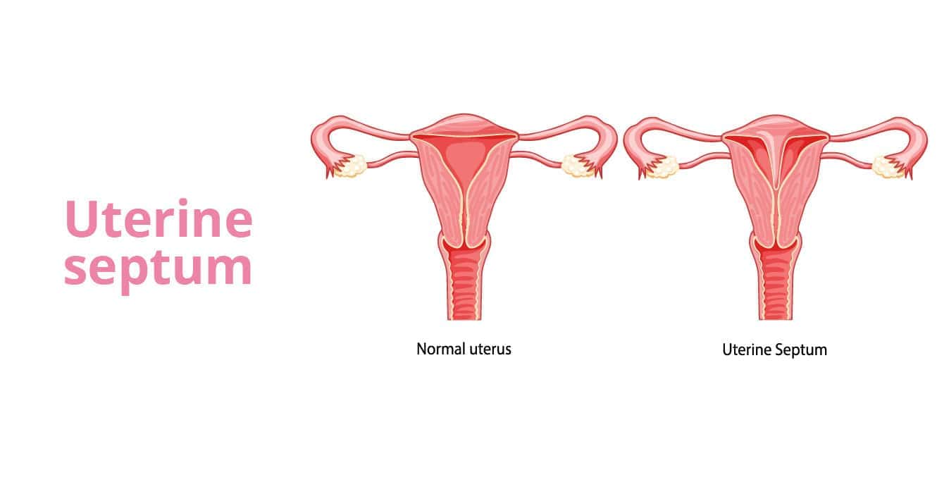 सेप्टम रिमूवल: आपके गर्भाशय स्वास्थ्य के बारे में सब कुछ जानने के लिए