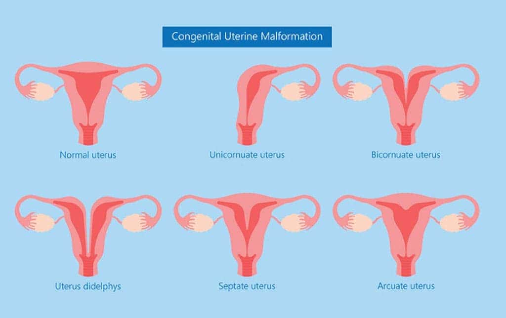 गर्भाशय संबंधी असामान्यताएं