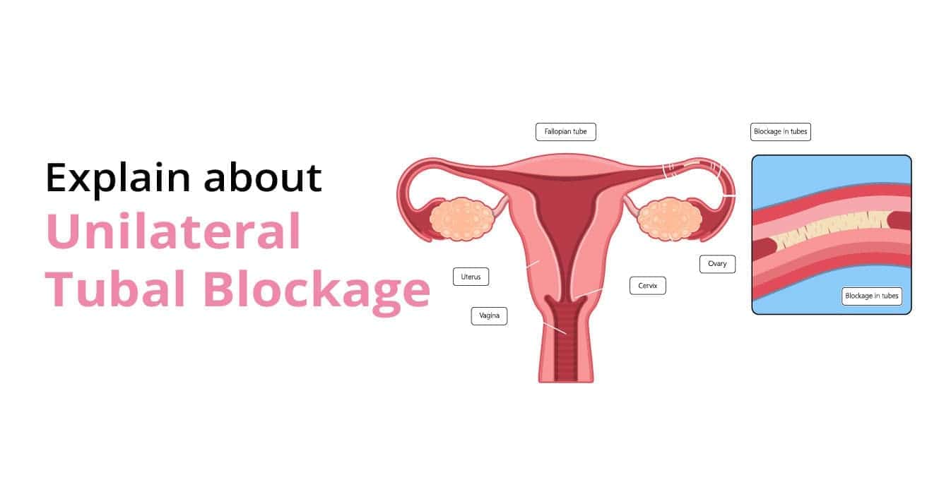 What is the Unilateral Tubal Blockage?