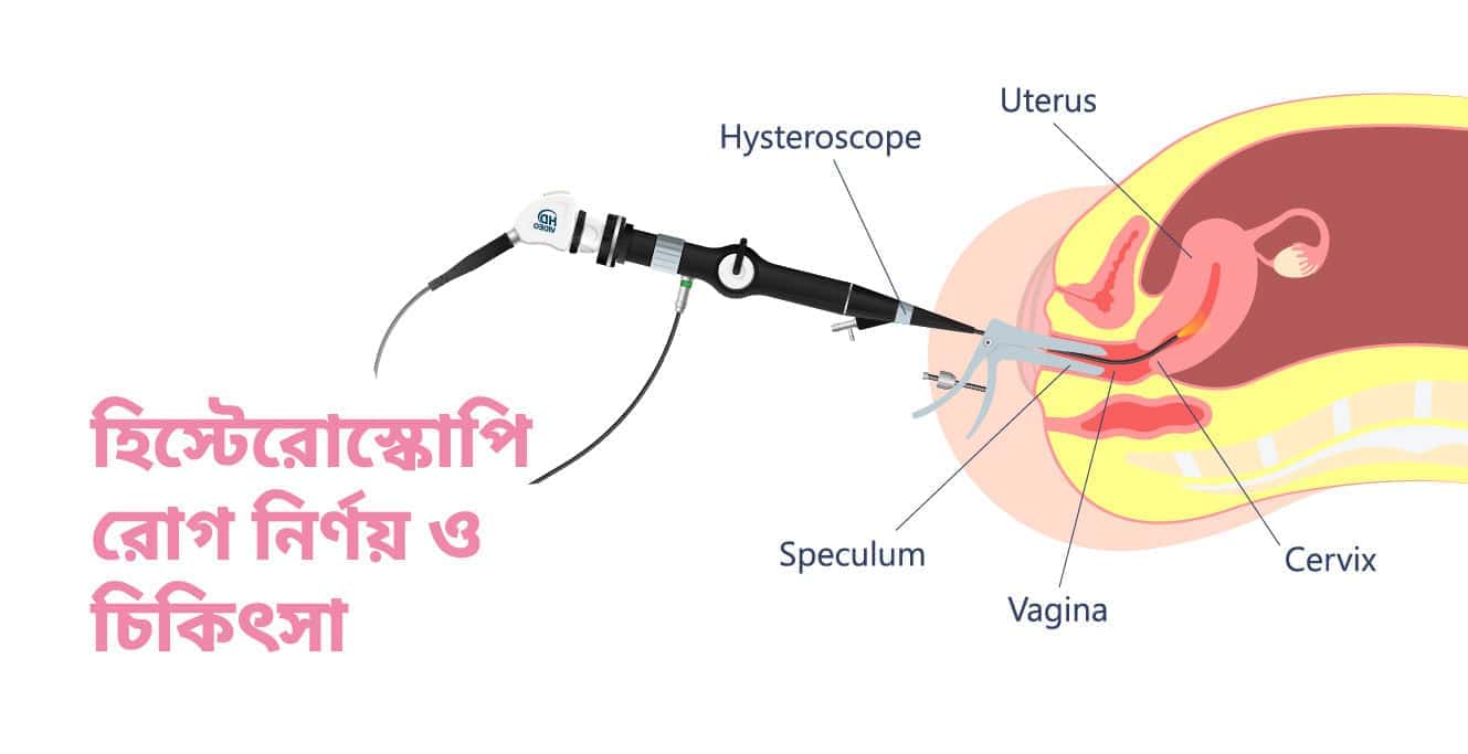 জরায়ুর সমস্যা দূর হিস্টেরোস্কোপি-তে 