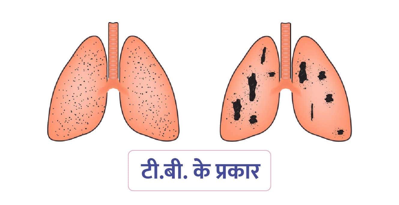Tuberculosis in Hindi: ट्यूबरक्लोसिस क्या है? लक्षण, प्रकार और उपचार