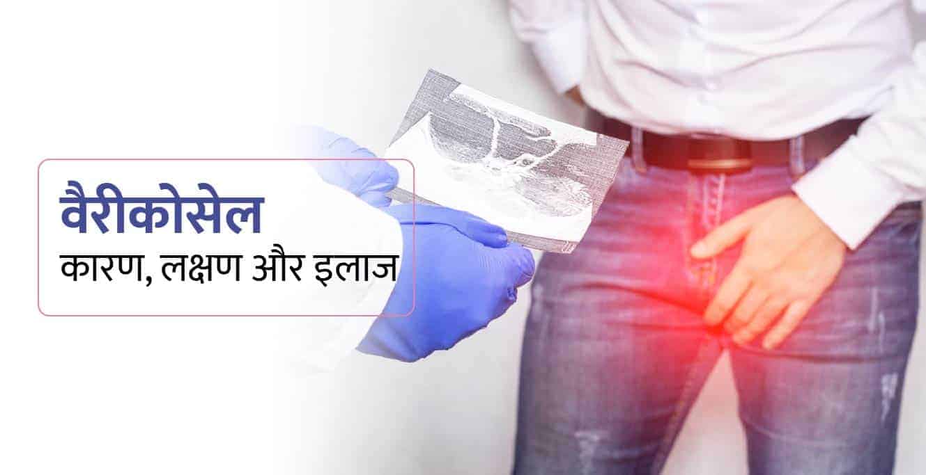 वैरीकोसेल का कारण, लक्षण और इलाज – Varicocele in Hindi