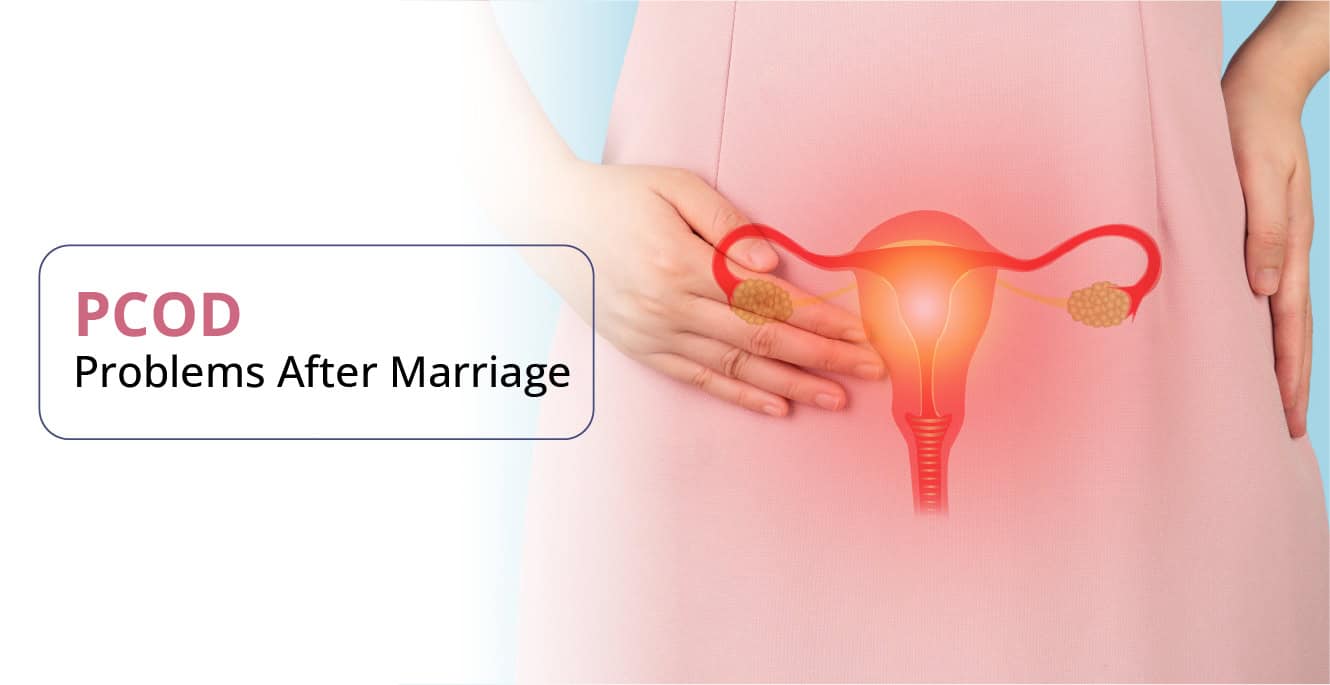 PCOD Problems After Marriage: Types, Symptoms, Causes & Treatment