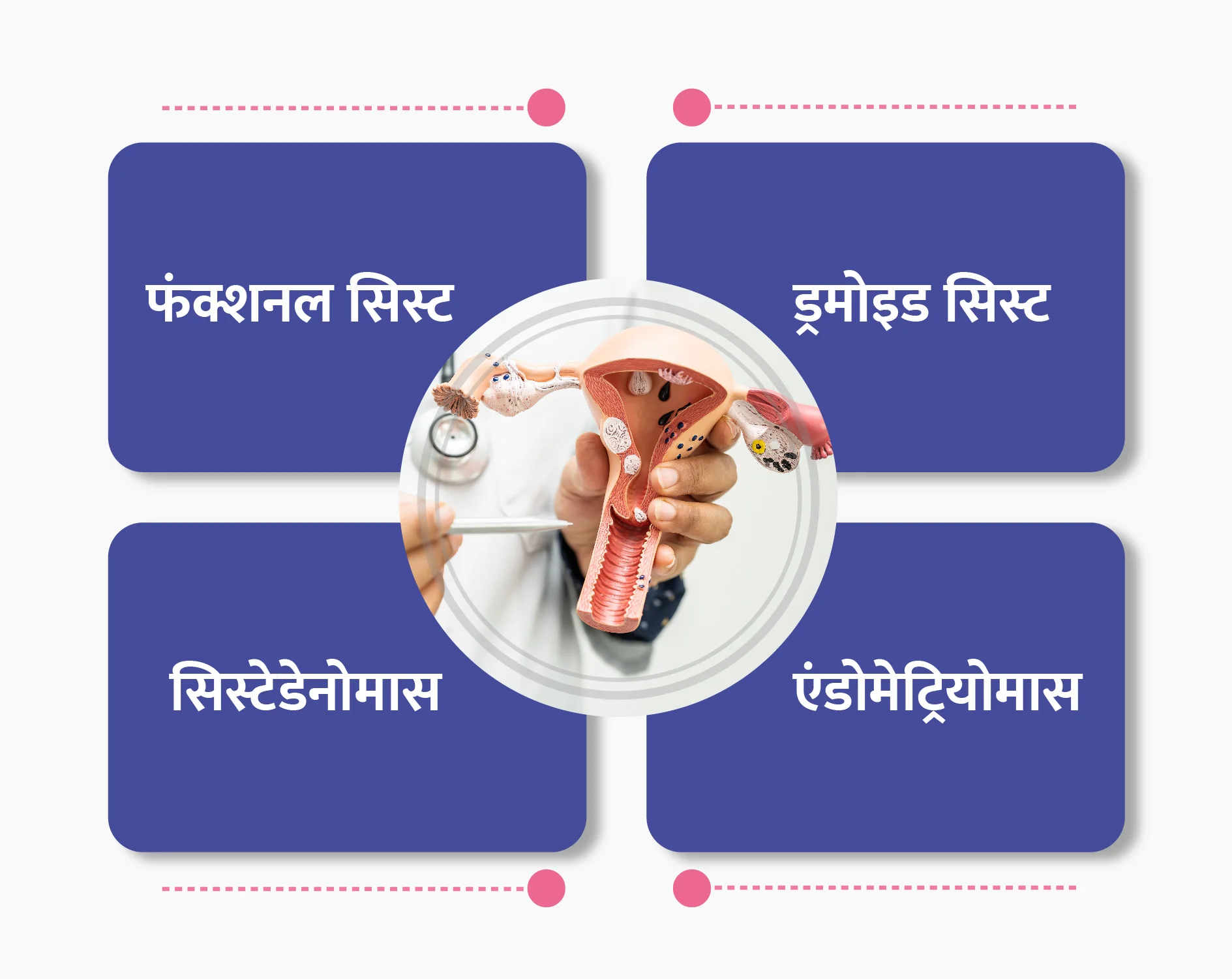 Types of Ovarian Cysts