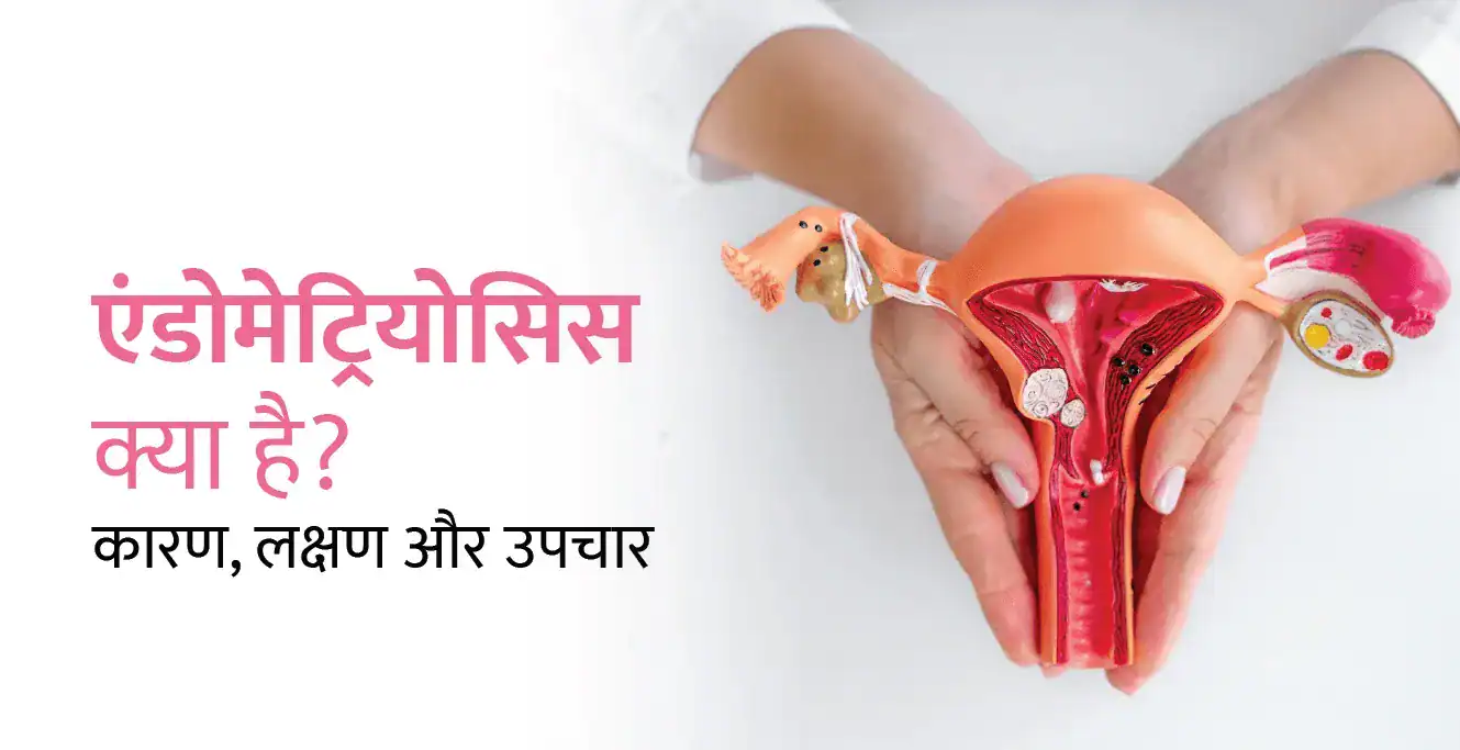 Endometriosis in Hindi – एंडोमेट्रियोसिस क्या है? कारण, लक्षण और उपचार