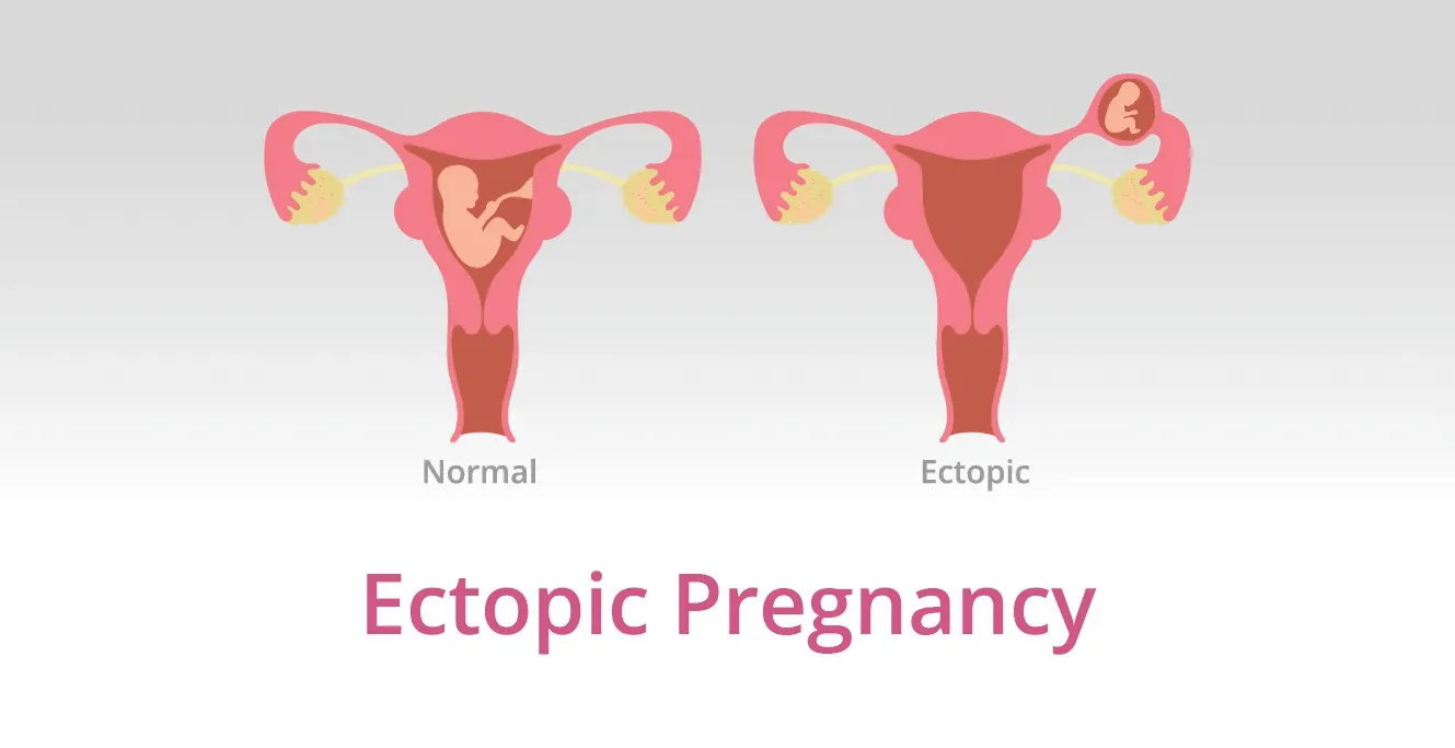 अस्थानिक गर्भावस्था क्या है?