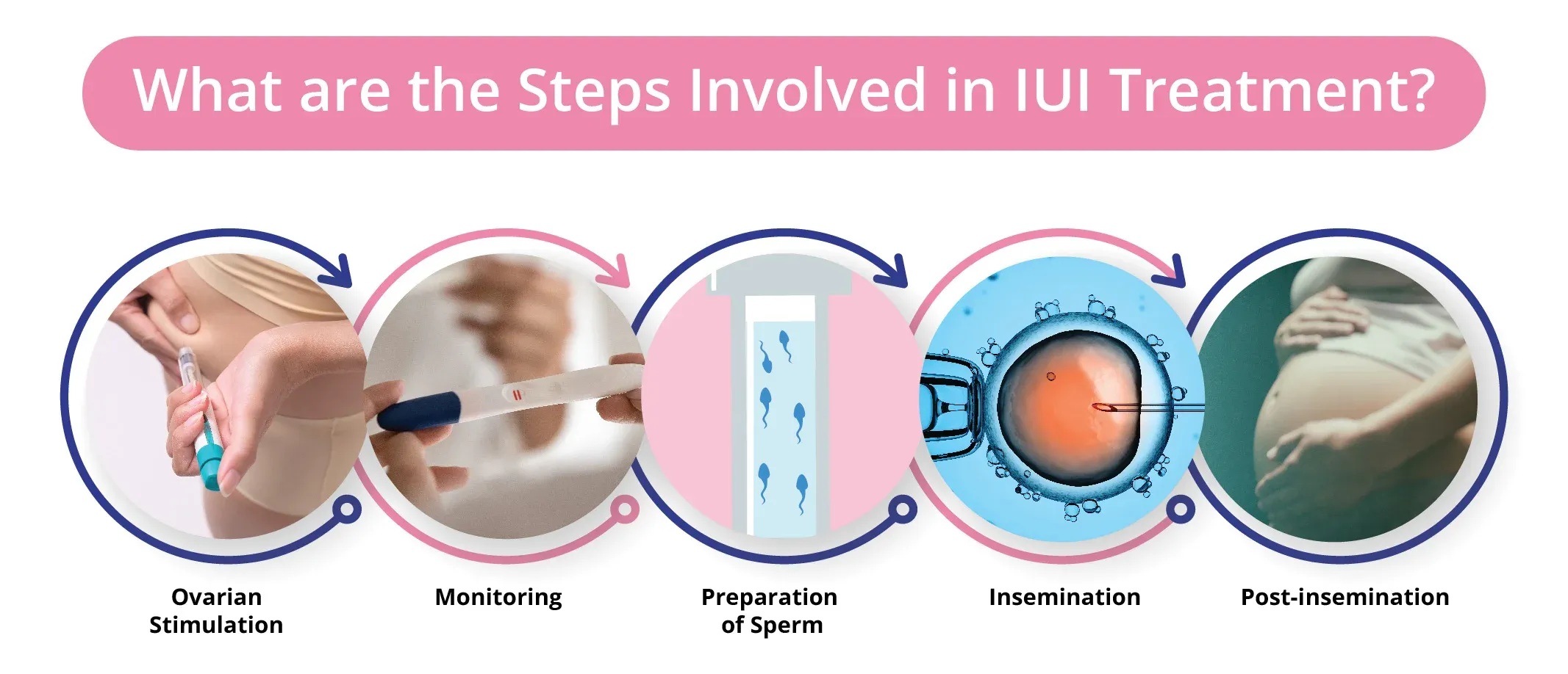 What are the Steps Involved in IUI Treatment