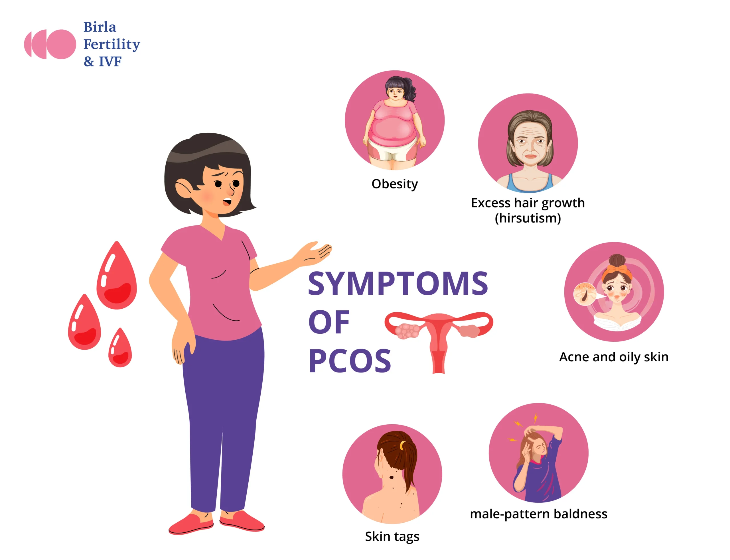 PCOS యొక్క లక్షణాలు