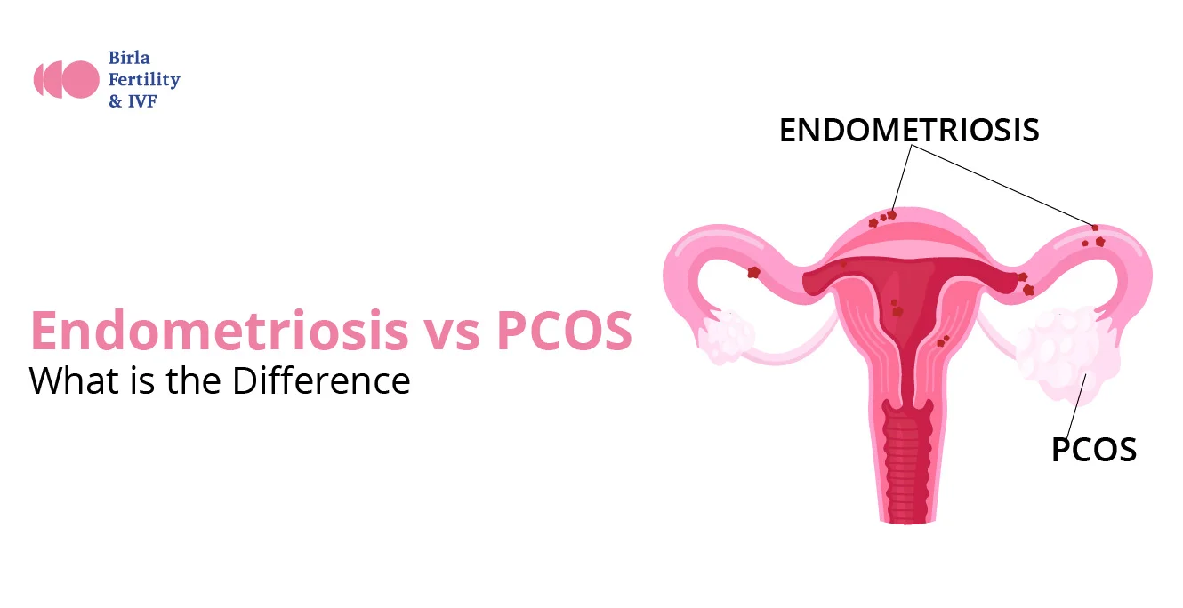 எண்டோமெட்ரியோசிஸ் vs PCOS: வித்தியாசம் என்ன?