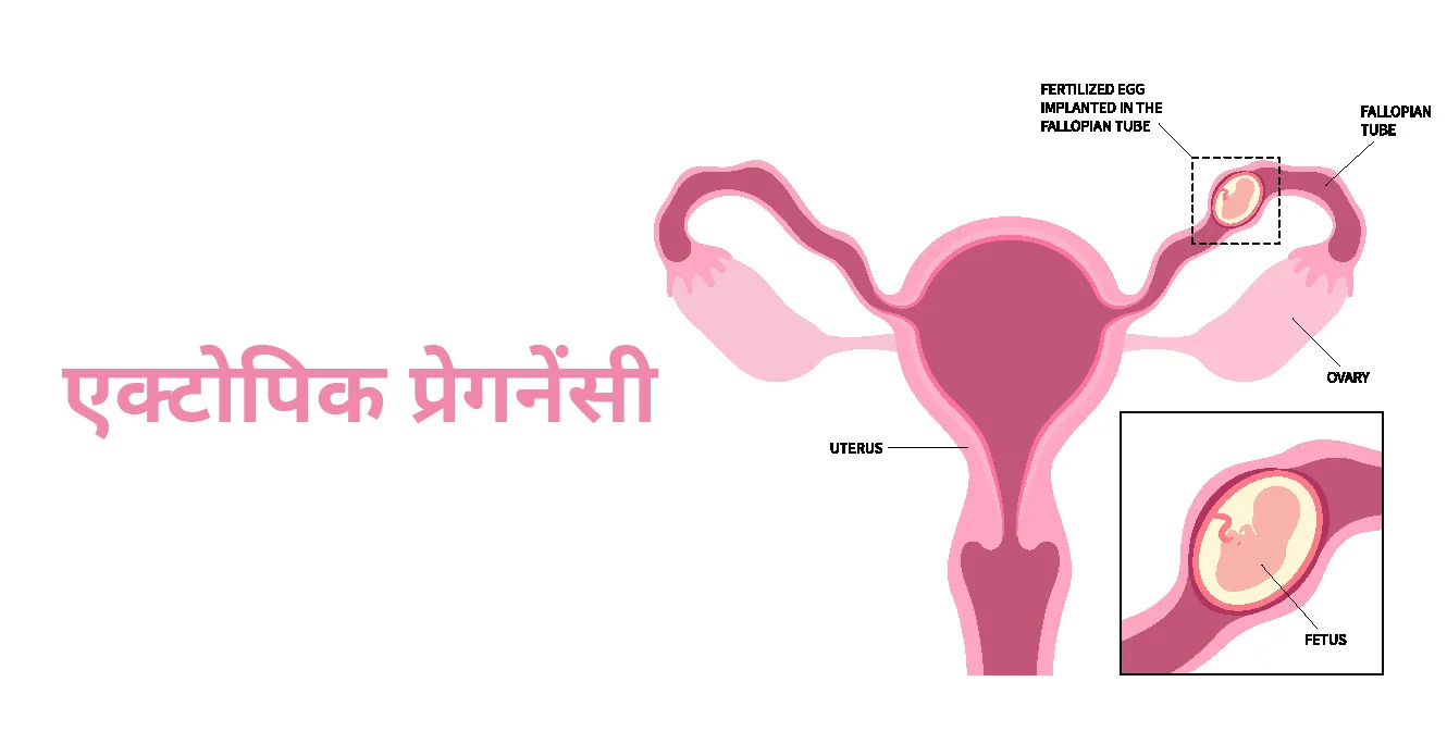 एक्टोपिक प्रेगनेंसी क्या है? कारण, लक्षण और उपचार