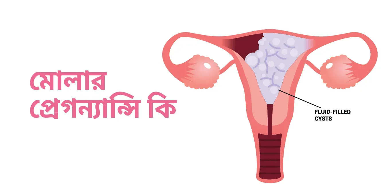 মোলার প্রেগন্যান্সি কি – কারণ, লক্ষণ ও চিকিৎসা – Molar Pregnancy in Bengali