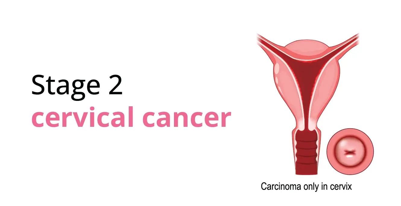 Stage 2 Cervical Cancer: Symptoms, Diagnosis, and Treatment