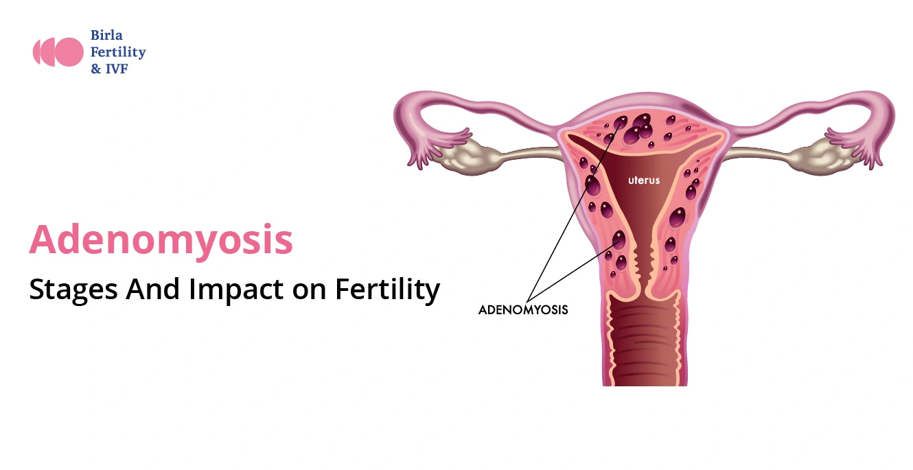 Adenomyosis: Stages And Impact on Fertility