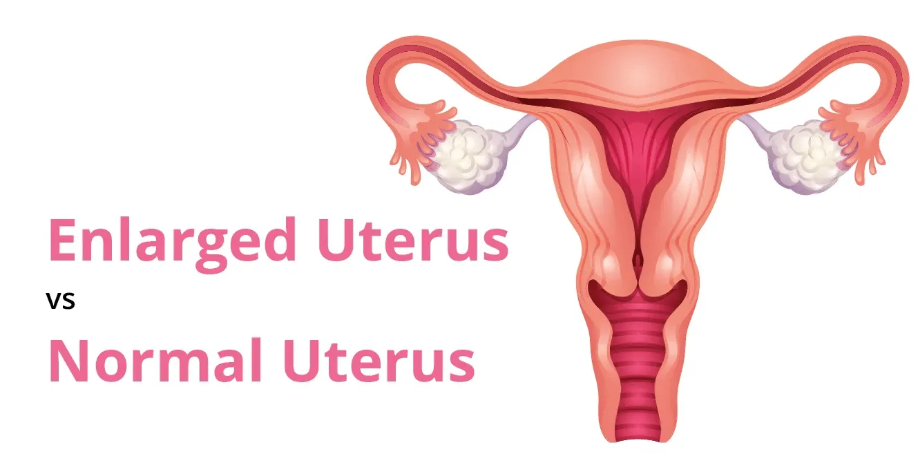 Enlarged Uterus (Adenomyosis) Vs. Normal Uterus: Overview